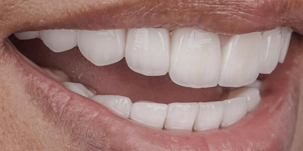The after of the close-up smile of patient three