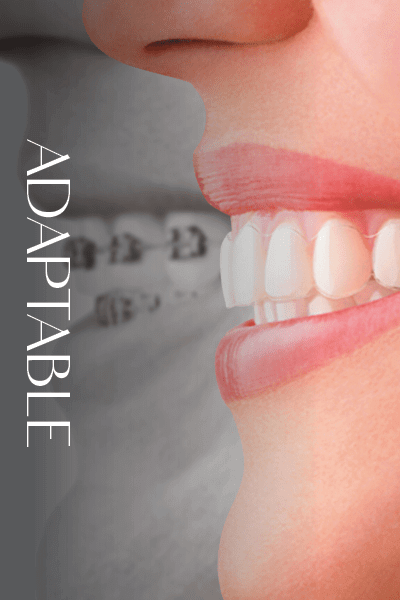 Close up of a smile with Invisalign